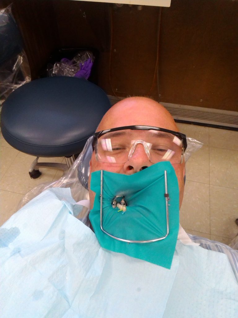 In this phot a metal frame is supporting a dental dam which is leaving a few teeth exposed tobe worked on. I'm waeering safety glasses and have a paper bib on my chest.